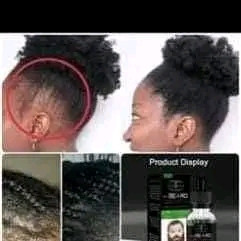 pousse-de-barbes-reglage-de-chute-de-cheveux-calvitie-big-1